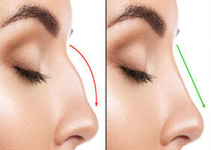 perth-non-surgical-rhinoplasty