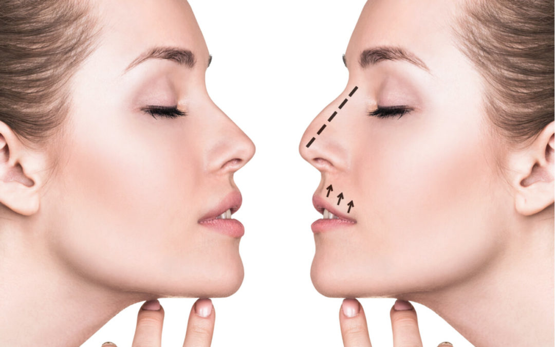 Rhinoplasty: Before And After The Procedure (What To Expect)
